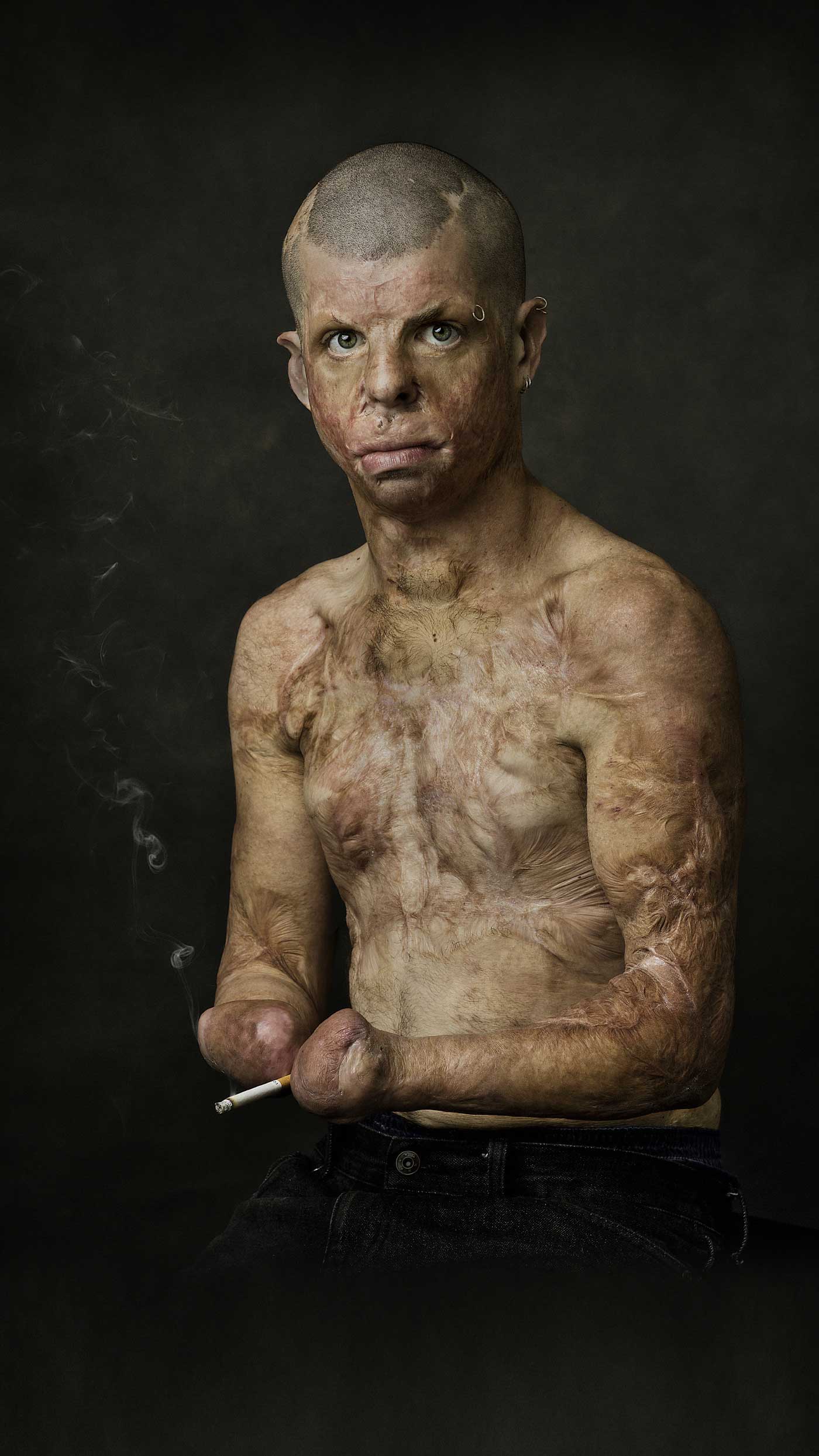 Photo portrait of a man set against a black background. He stares solemnly at the camera, his torso is bare a covered with scars, he hold a cigarette with his wrists as he has no hands